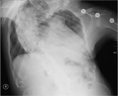 Radiograph from the case bank: Scoliosis