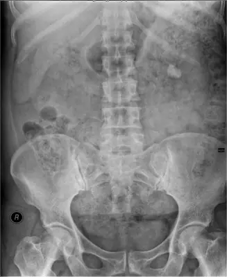 Radiograph from the case bank: Urinary tract calculi (kidney or ureteric stones)