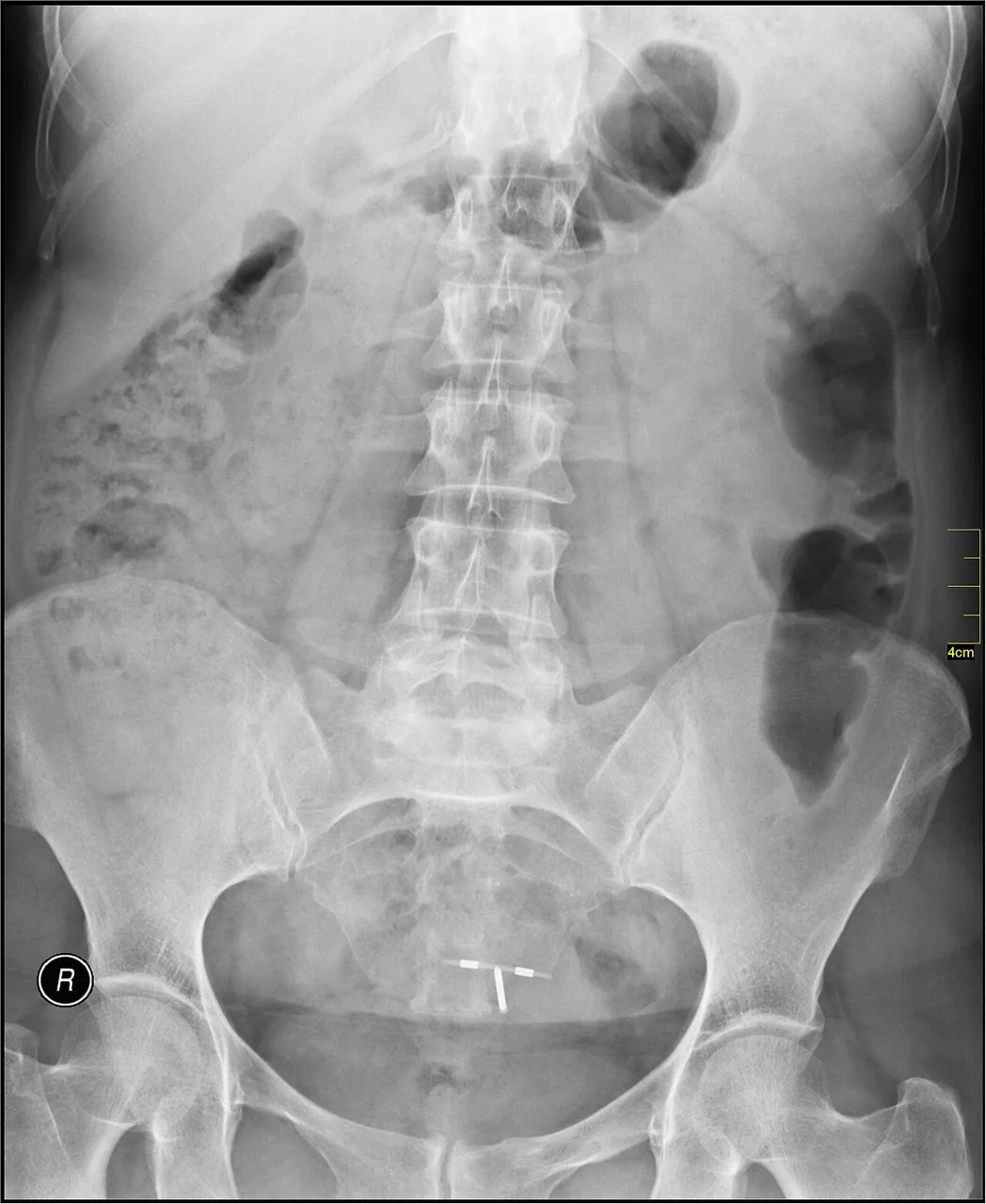 Abdomen radiograph for self-assessment