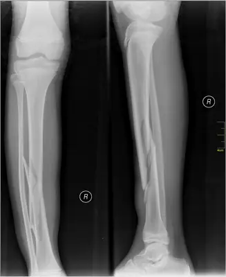Radiograph from the case bank: Tibial (and fibular) shaft fracture