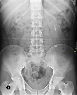 Radiograph from the case bank: Urinary tract calculi (kidney or ureteric stones)