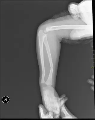 Radiograph from the case bank: Forearm shaft fracture (radius and ulna)