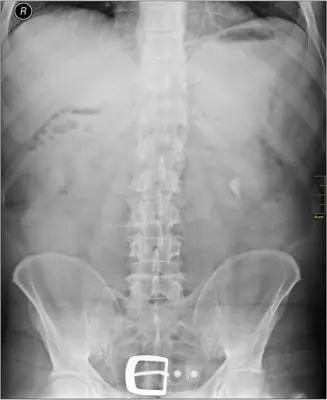 Radiograph from the case bank: Urinary tract calculi (kidney or ureteric stones)