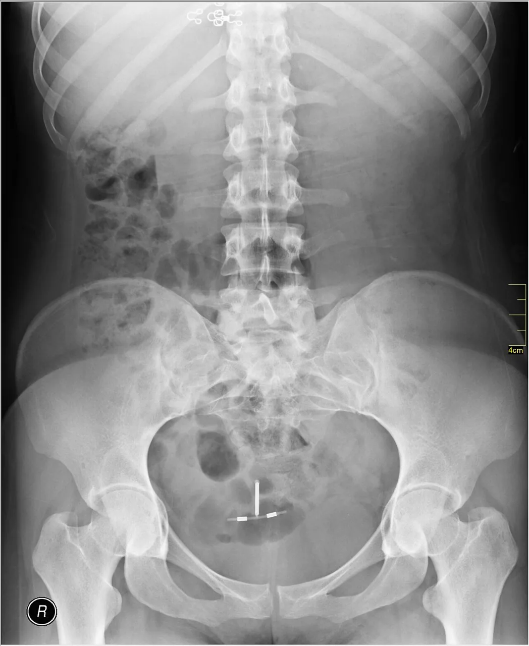Abdomen radiograph for self-assessment