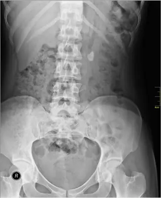 Radiograph from the case bank: Urinary tract calculi (kidney or ureteric stones)
