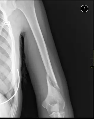 Radiograph from the case bank: Humeral shaft fracture