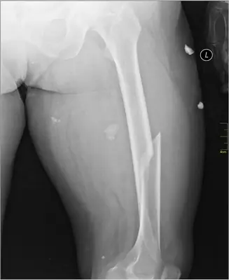 Radiograph from the case bank: Femoral shaft fracture