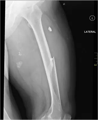 Radiograph from the case bank: Femoral shaft fracture