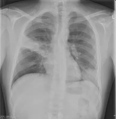 Radiograph from the case bank: Pneumonia (consolidation)