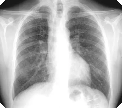 Radiograph from the case bank: Silicosis / pneumoconiosis