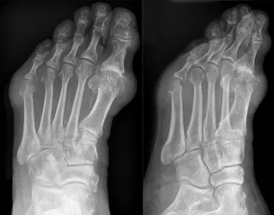 Radiograph from the case bank: Gout