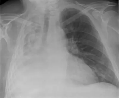 Radiograph from the case bank: Lung collapse (atelectasis)