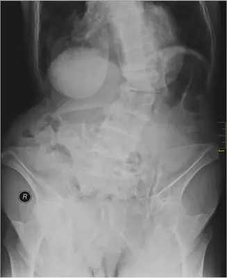 Radiograph from the case bank: Scoliosis