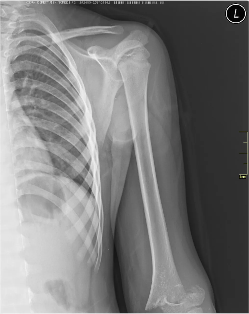Upper limb radiograph for self-assessment