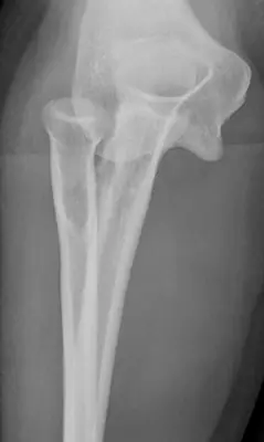 Radiograph from the case bank: Elbow dislocation
