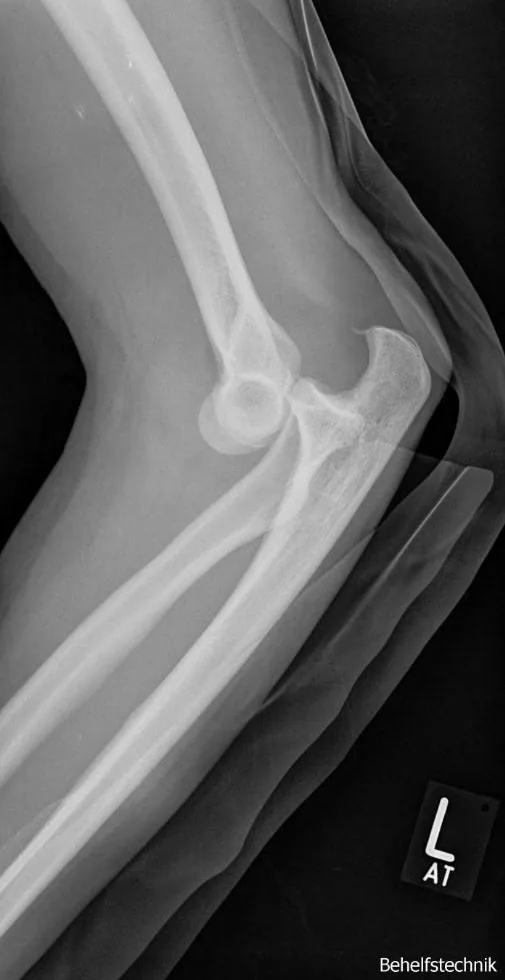 Upper limb radiograph for self-assessment