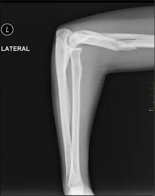 Radiograph from the case bank: Humeral shaft fracture