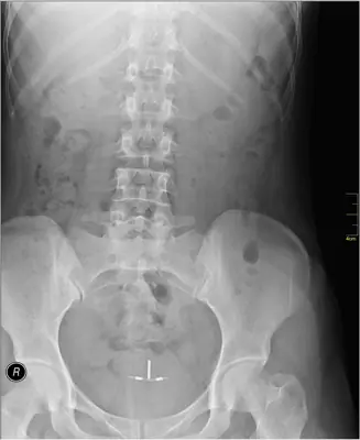 Radiograph from the case bank: Intrauterine contraceptive device (IUCD)