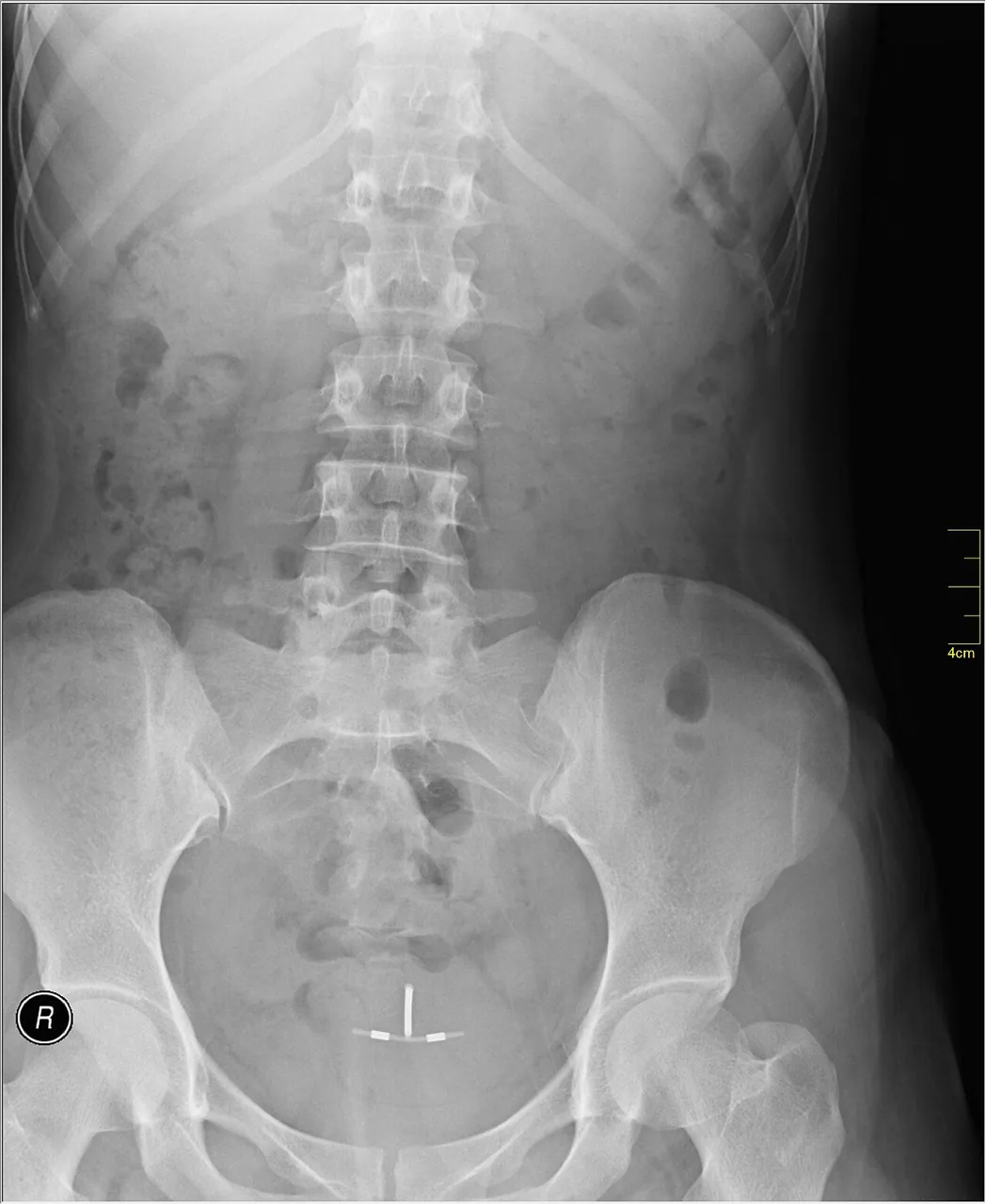 Abdomen radiograph for self-assessment