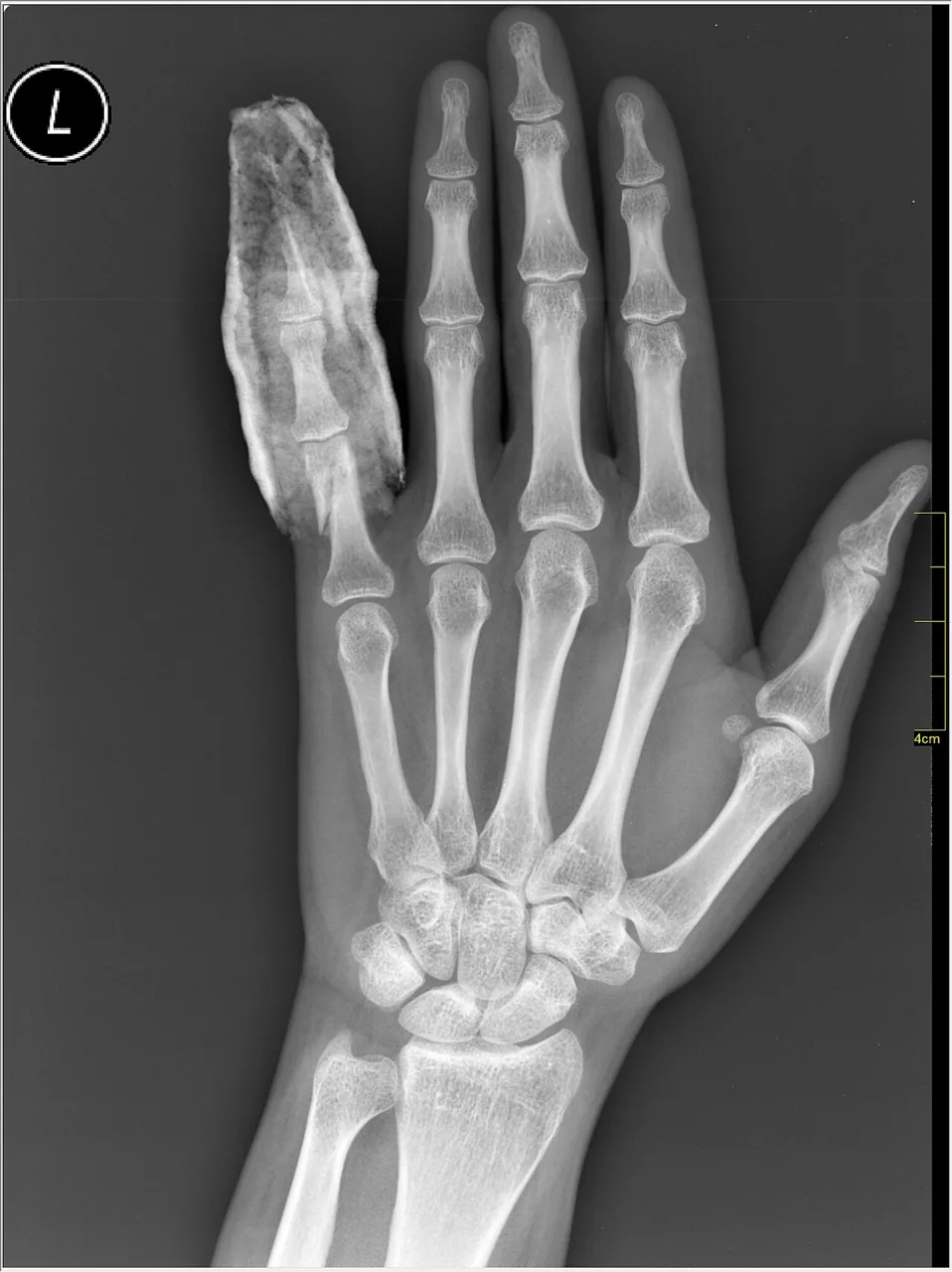 Upper limb radiograph for self-assessment