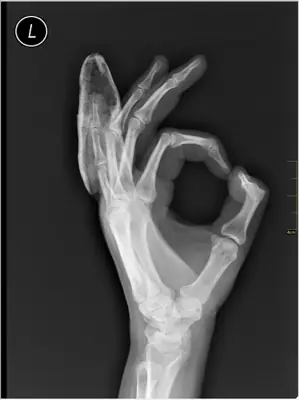Radiograph from the case bank: Finger (phalangeal) fracture