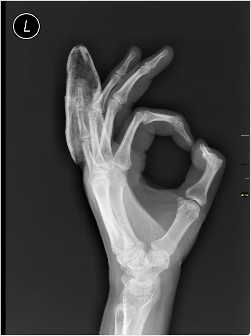 Upper limb radiograph for self-assessment