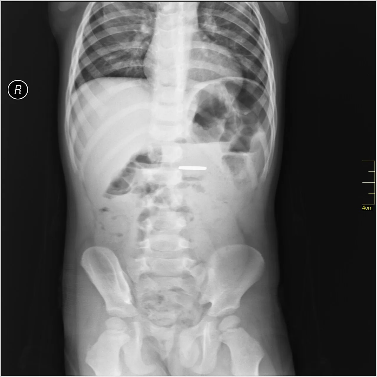 Abdomen radiograph for self-assessment