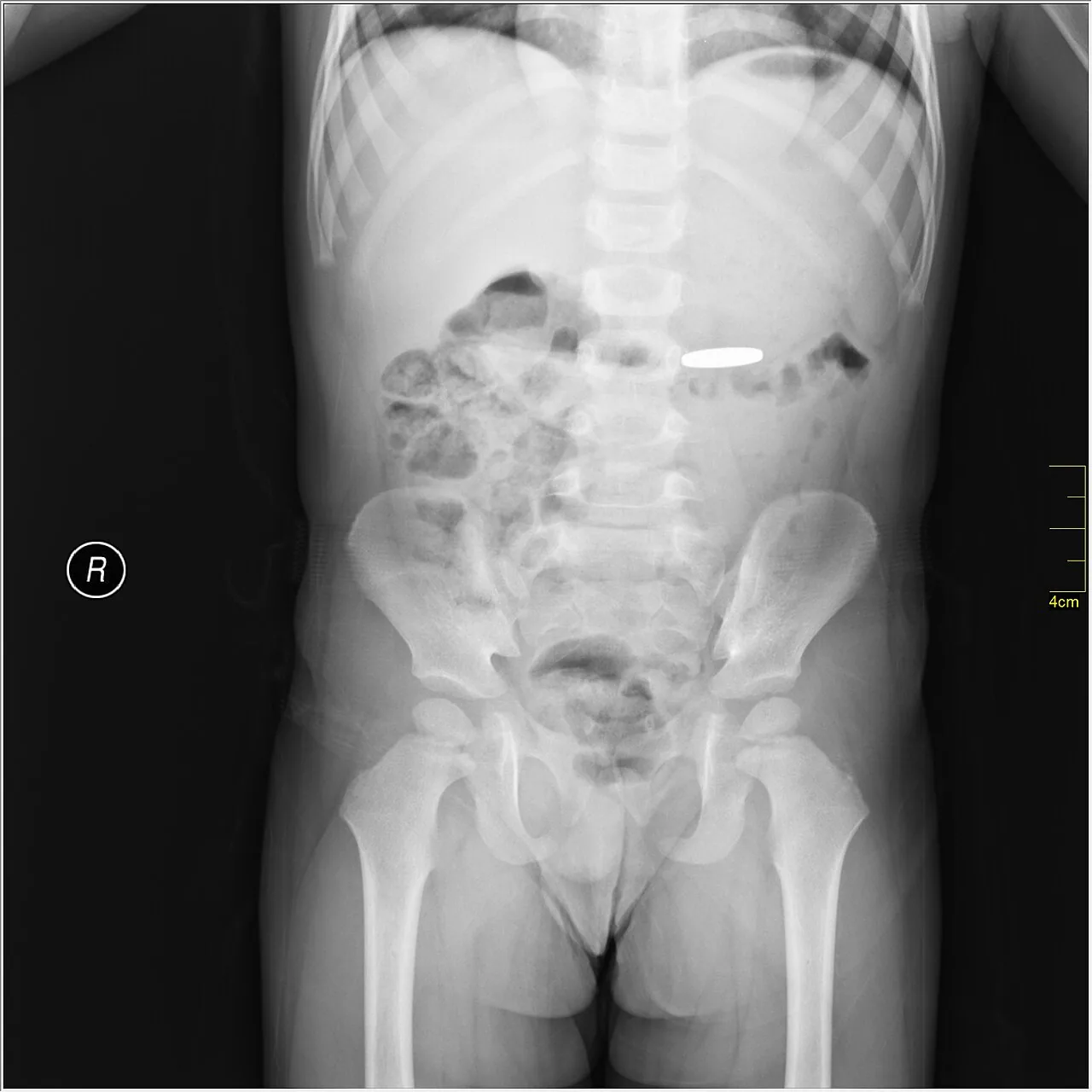 Abdomen radiograph for self-assessment
