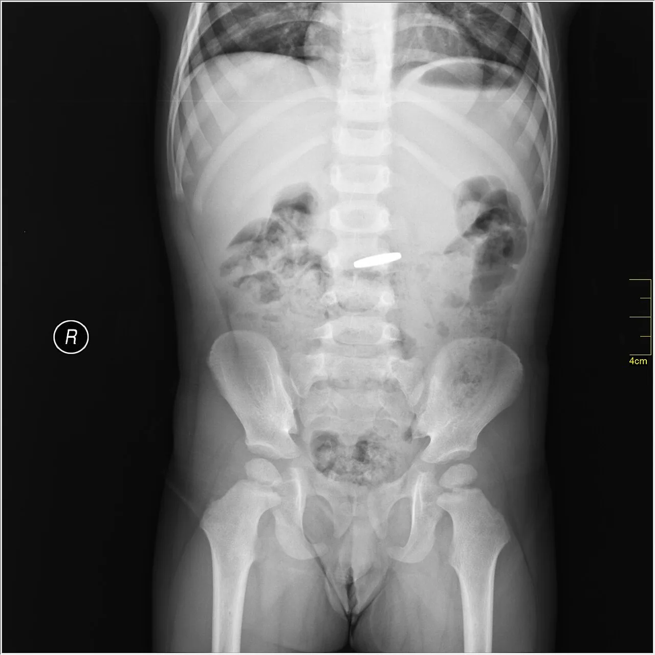 Abdomen radiograph for self-assessment