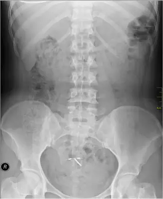 Radiograph from the case bank: Intrauterine contraceptive device (IUCD)