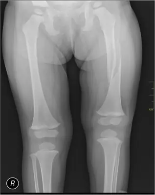 Radiograph from the case bank: Femoral shaft fracture