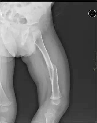 Radiograph from the case bank: Femoral shaft fracture