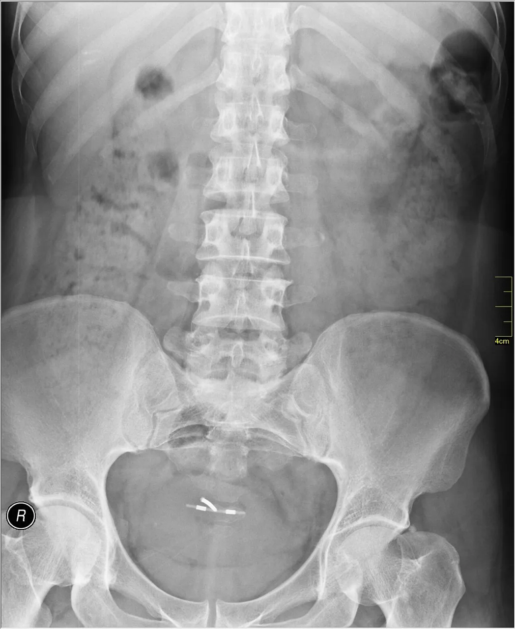 Abdomen radiograph for self-assessment
