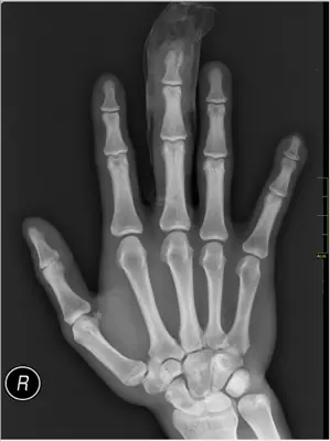 Radiograph from the case bank: Finger (phalangeal) fracture