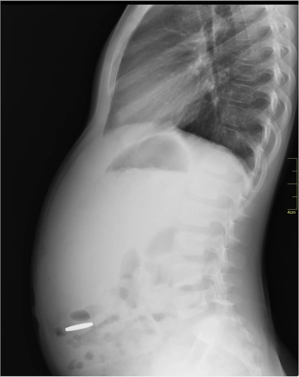 Abdomen radiograph for self-assessment