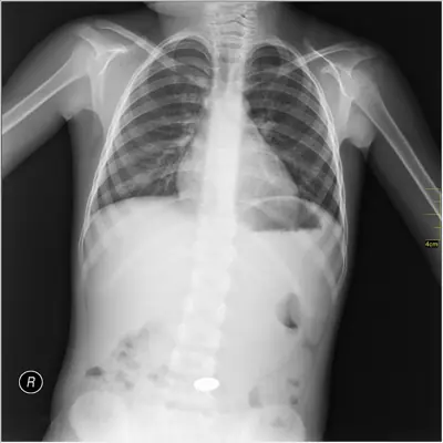 Radiograph from the case bank: Foreign body (ingested or inserted)