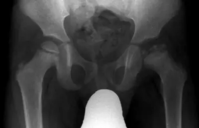 Radiograph from the case bank: Perthes disease