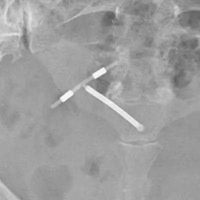 Radiograph from the case bank: Intrauterine contraceptive device (IUCD)
