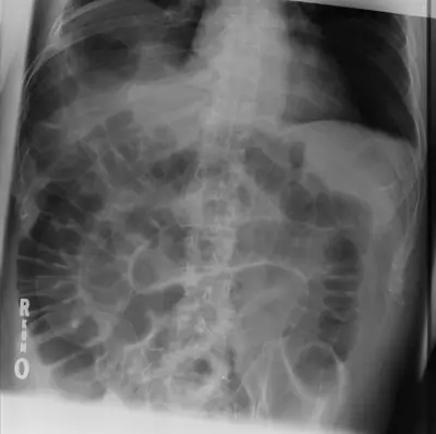 Radiograph from the case bank: Pneumoperitoneum (free intraperitoneal gas)