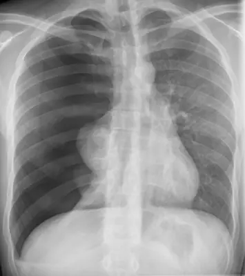 Radiograph from the case bank: Pneumothorax