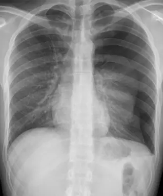 Radiograph from the case bank: Pneumothorax