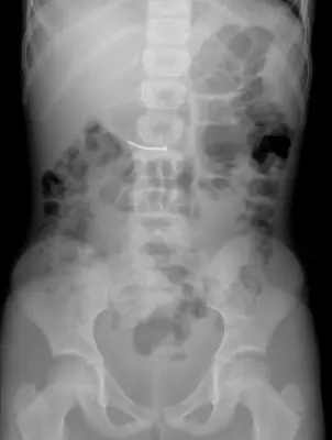 Radiograph from the case bank: Foreign body (ingested or inserted)