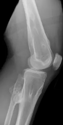 Radiograph from the case bank: Osteochondroma (exostosis)