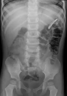 Radiograph from the case bank: Foreign body (ingested or inserted)