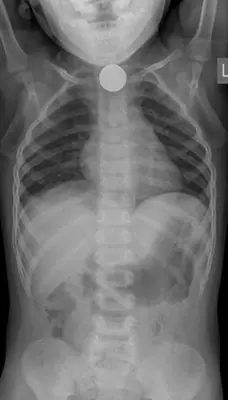 Radiograph from the case bank: Foreign body in the oesophagus