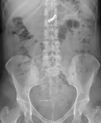 Radiograph from the case bank: Foreign body (ingested or inserted)