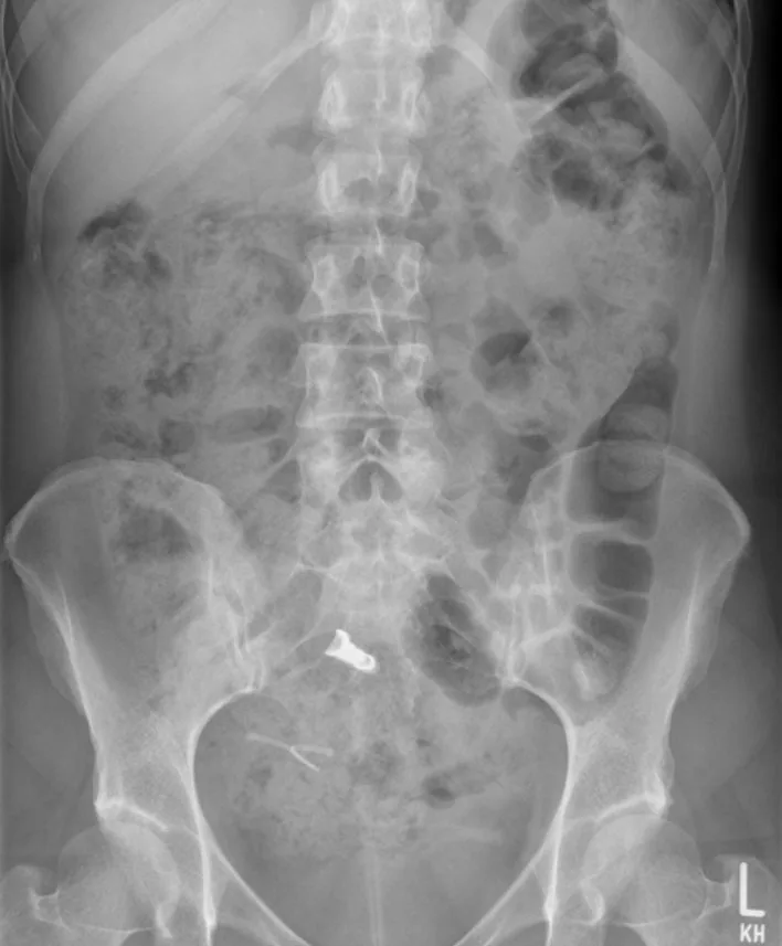 Abdomen radiograph for self-assessment