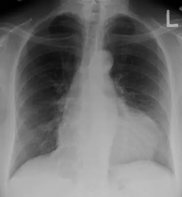 Radiograph from the case bank: Pericardial effusion