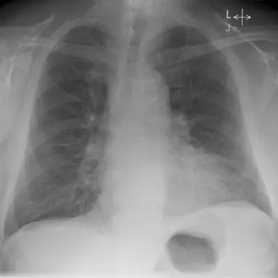 Radiograph from the case bank: Pulmonary oedema (heart failure)