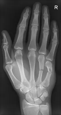 Radiograph from the case bank: Metacarpal fracture